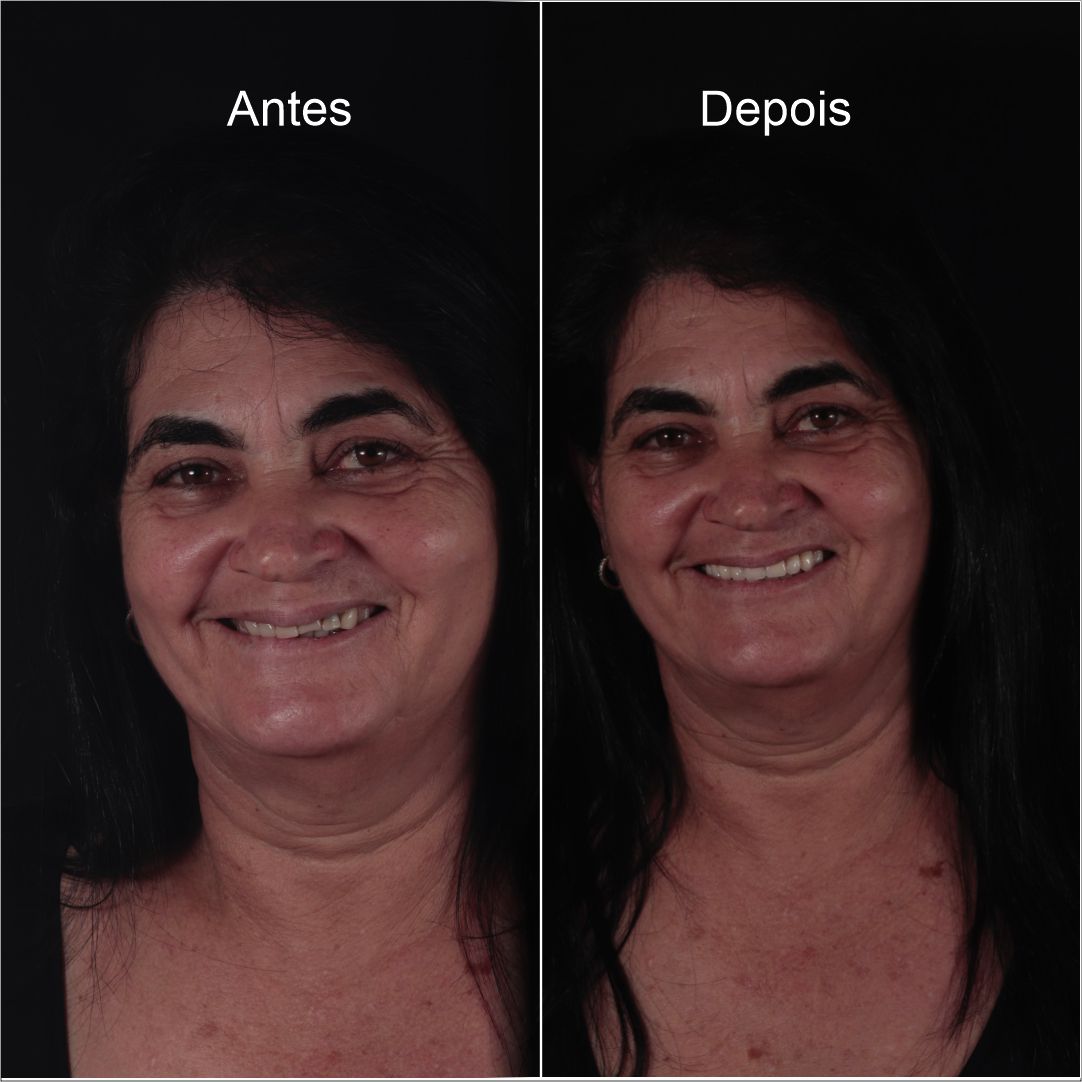 antes e depois